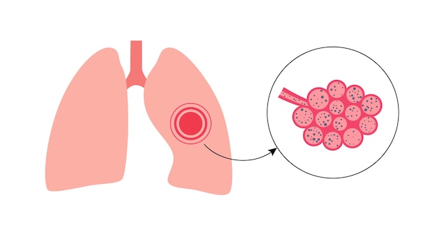 Vektor lungenerkrankung pneumokoniose