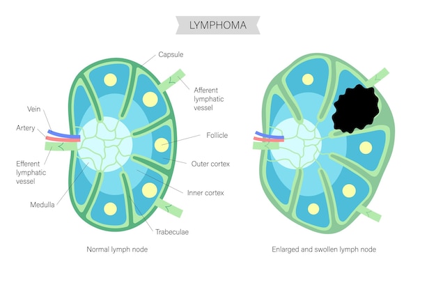 Vektor lymphom-krebs-konzept