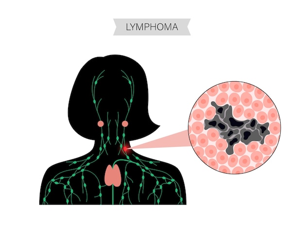 Vektor lymphom-krebs-konzept