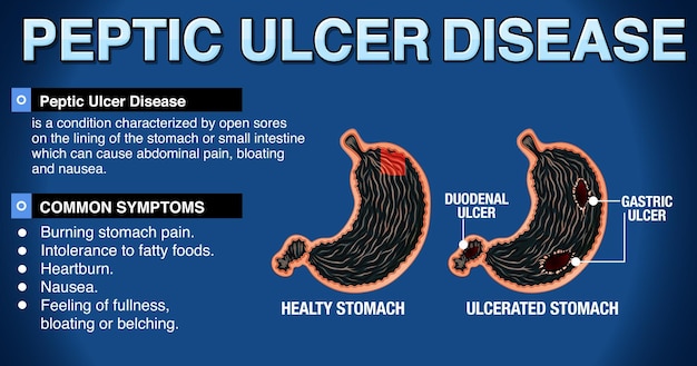 Vektor magengeschwüre erklärt infografik