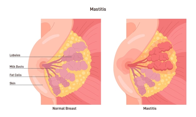 Mastitis brustdrüse mit entzündung der brust lobular