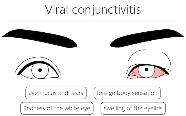 Vektor medizinische clipart strichzeichnung illustration von augenkrankheiten und viraler konjunktivitis