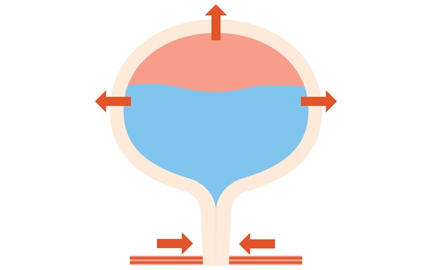 Vektor medizinische darstellung der normalen blase, wie sie uriniert und wie sie urin speichert