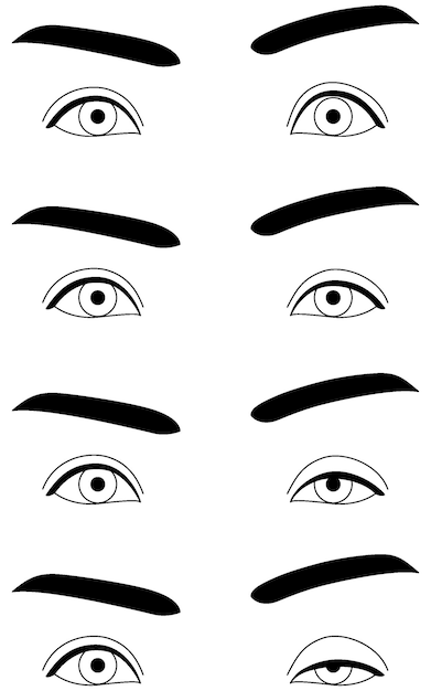 Vektor medizinische illustration ptosis-symptome normal bis schwer