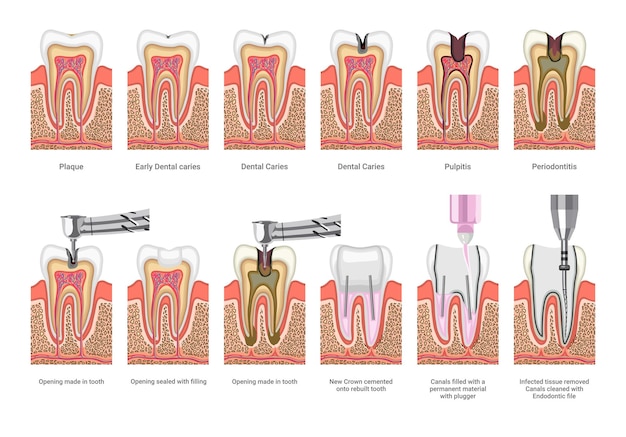 Vektor medizinische illustrationen zur zahnbehandlung