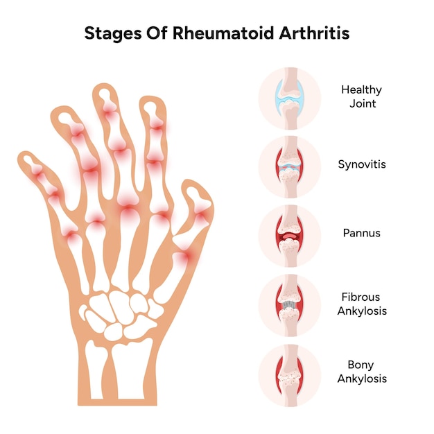 Medizinische Infografik über das Stadium der rheumatoiden Gelenke