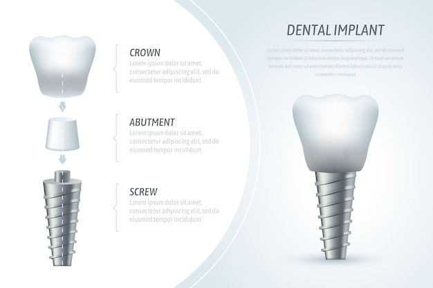 Medizinische infografik vorlage und zahnimplantat