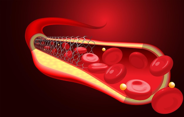 Medizinische und pädagogische illustrationen des bereits platzierten stents