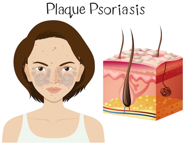 Vektor menschliche anatomie der plaque psoriasis