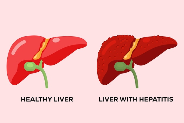 Menschliche gesunde leber und menschliche leber mit hepatitis