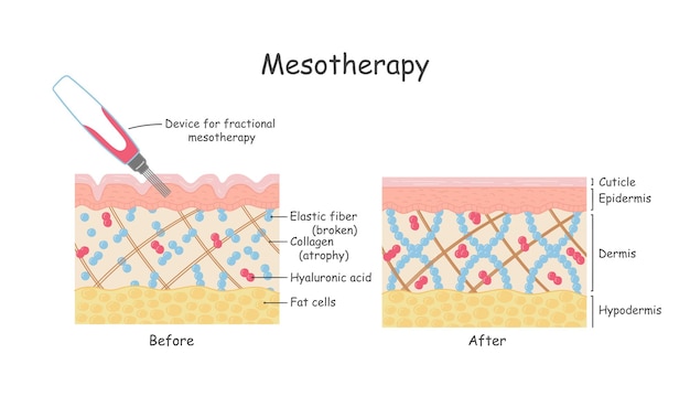 Mesotherapie für die Haut anatomische Illustration im Cartoon-Stil