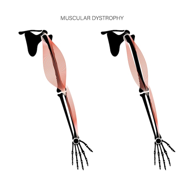Vektor muskeldystrophie des arms
