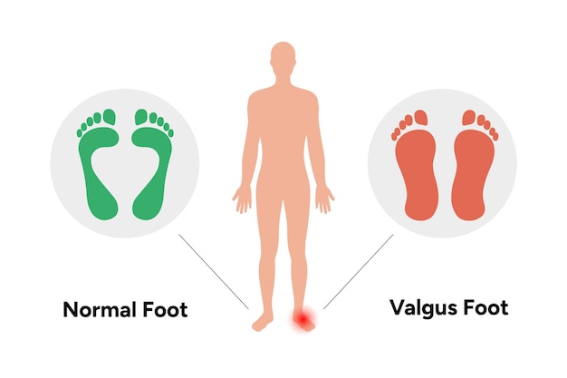 Normal- und Valgusfuß
