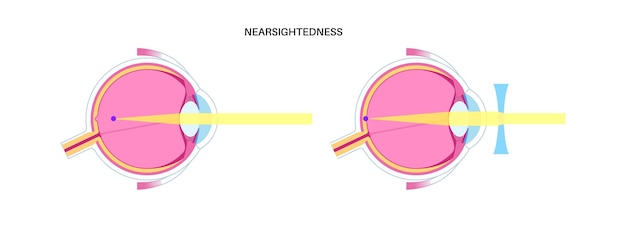 Vektor normales auge und kurzsichtigkeit