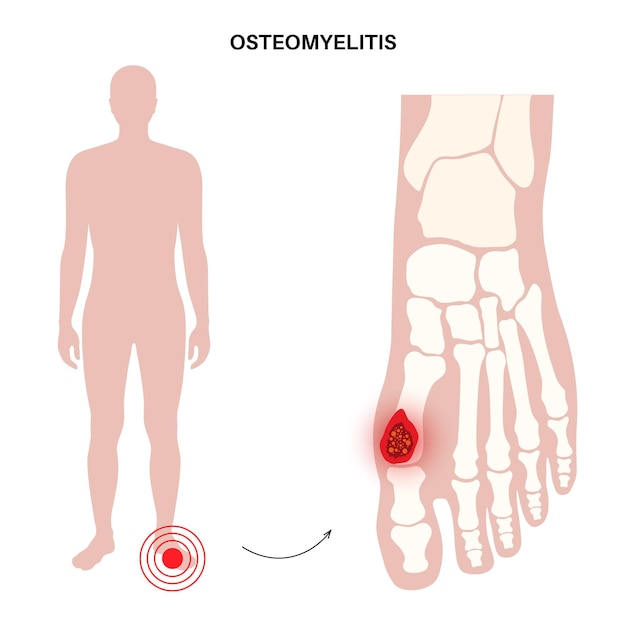 Osteomyelitis-Krankheit, infizierte Fußknochen, Schmerzen und darüber liegende Rötungen. Die Infektion breitet sich über den Blutkreislauf in den Fuß aus. Staphylococcus aureus-Bakterien im menschlichen Körper, Vektorillustration
