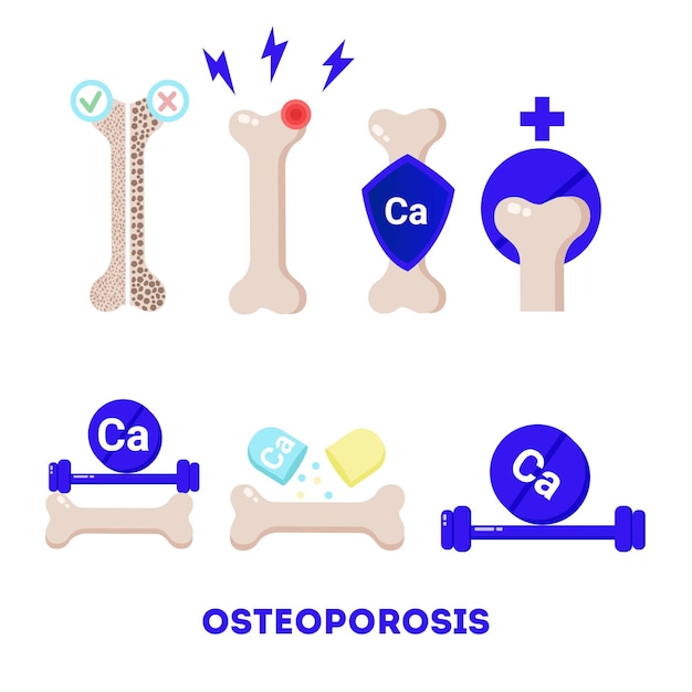 Osteoporose-vektorillustrationen eingestellt. medizinische orthopädische illustrationen von knochen und kalzium