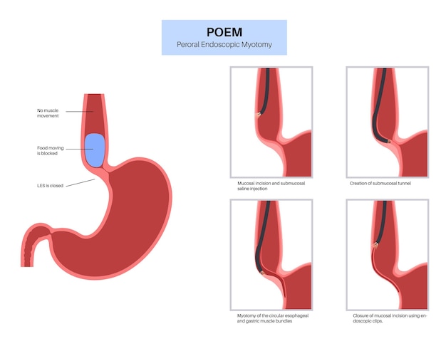 Perorale endoskopische Myotomie POEM minimalinvasives Verfahren Störung der Speiseröhre Achalasie-Krankheit Geschlossener unterer Ösophagussphinkter gastroösophageale anatomische Postervektorillustration