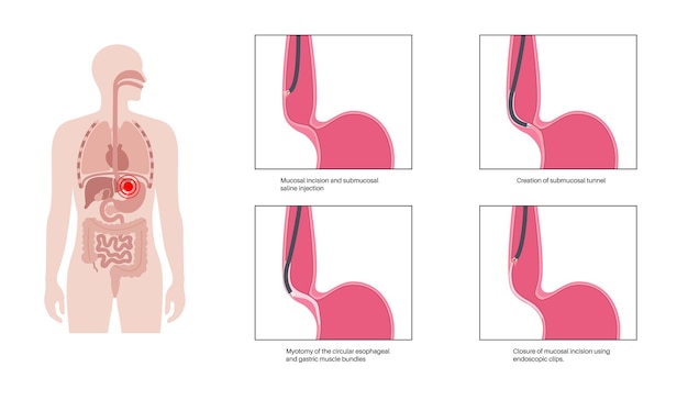 Vektor perorale endoskopische myotomie poem minimalinvasives verfahren störung der speiseröhre achalasie-krankheit geschlossener unterer ösophagussphinkter gastroösophageale anatomische postervektorillustration