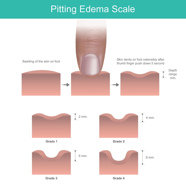 Vektor pitting-ödemschale hautverletzungen tiefenbereich messung auf dem fuß