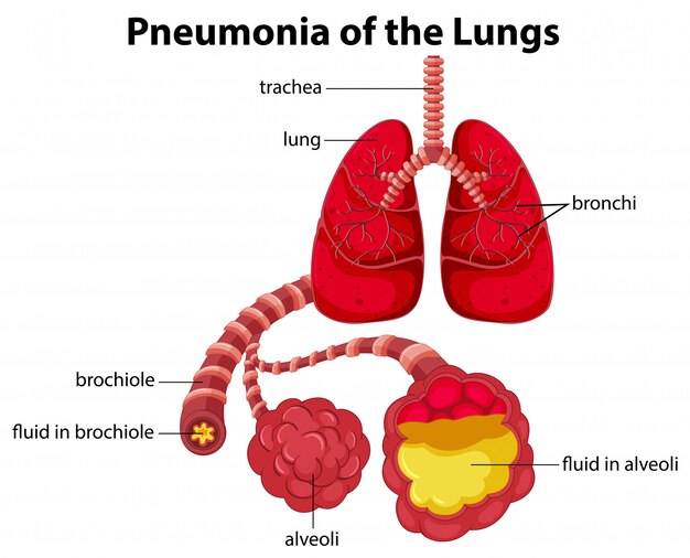 Pneumonie des lungen-diagramms