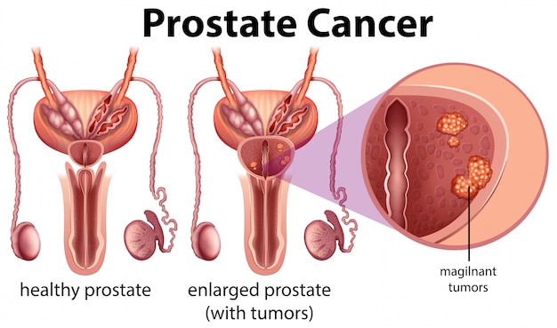 Prostatakrebs auf weißem hintergrund