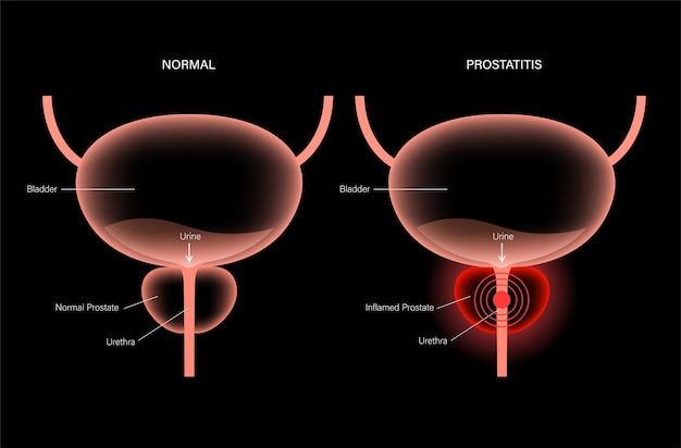 Prostatitis-entzündungsproblem