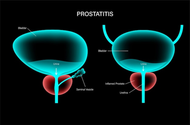 Vektor prostatitis-entzündungsproblem