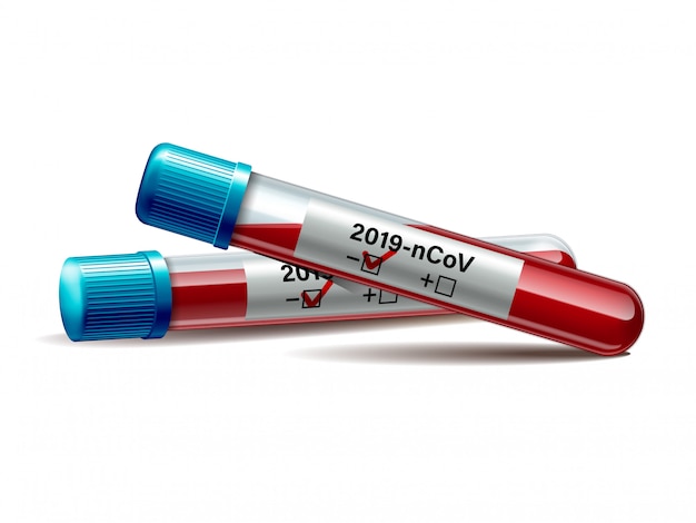 Reagenzglas mit Blutprobe für COVID-19, Coronavirus-Test.