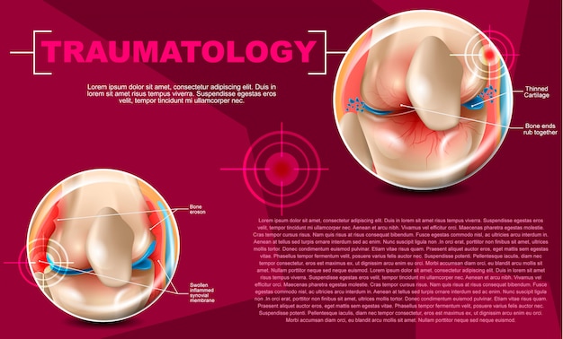 Realistische illustrations-traumatologie-medizin in 3d