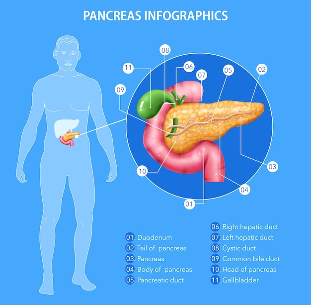 Realistische infografiken zur bauchspeicheldrüsenanatomie mit menschlicher körpersilhouette und inneren organen mit bearbeitbaren textunterschriften, zeigervektorillustration