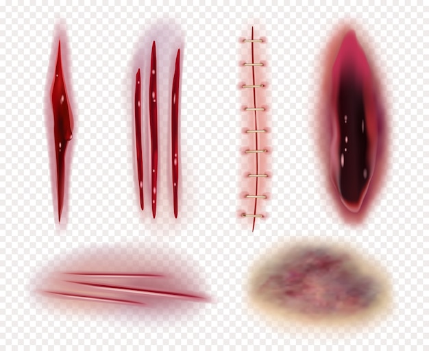 Vektor realistische narben. schneidet wunden blutergüsse blutergüsse blutstiche vorlagen sammlung. illustration verletzung trauma, grobe schnittfärbung