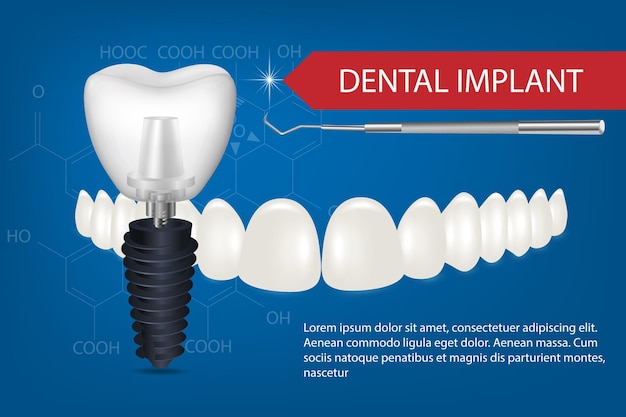 Realistisches weißes zahnimplantat auf blauem hintergrund mit schönen zähnen
