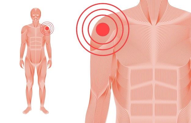 Schmerzen in schulter oder schulterblatt. muskelsystem mann silhouette. gelenke und knorpel im menschlichen körper