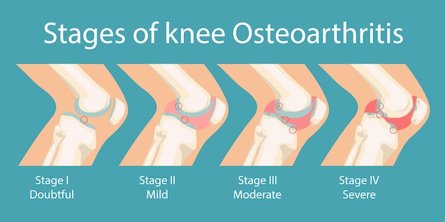 Stadien arthrose der knie arthrose beim menschen