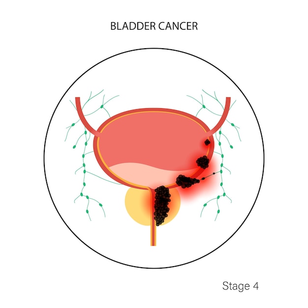 Stadien von blasenkrebs