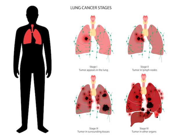 Vektor stadien von lungenkrebs