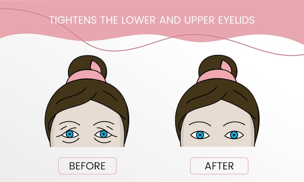 Strafft das untere und obere augenlid. laserkosmetologie vor dem eingriff und nach der behandlung. illustration einer frau mit und ohne falten