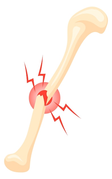Vektor symbol für gebrochenen knochen cartoon medizinische fraktur illustration
