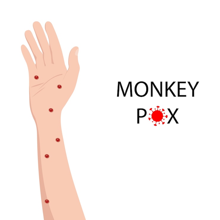 Vektor symptom von affenpocken an der menschlichen hand affenpocken
