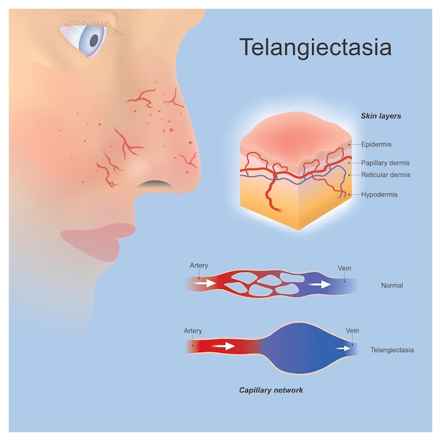 Teleangiektasie problem kleine blutgefäße erweitert oder gebildet in der nähe von oberflächenschichten der haut und sie können deutlich sehen