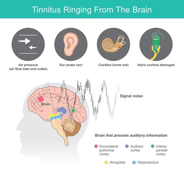 Vektor tinnitus ringing from the brain ist der begriff für ein summendes geräusch in ihren ohren, das von anormalen symptomen in den ohren oder im gehirn verursacht wirdxa