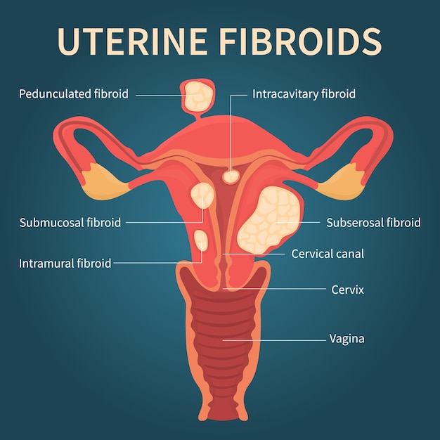 Uterusmyome im weiblichen fortpflanzungssystem