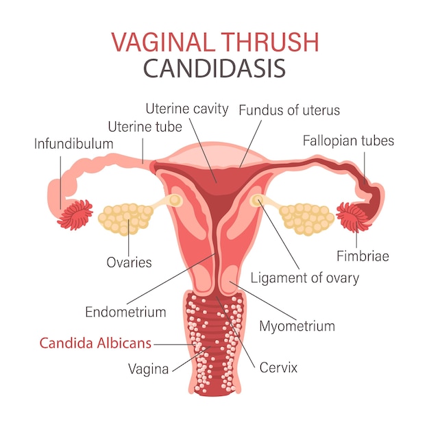 Vektor vaginale pilzinfektion candidiasis infografiken zu gynäkologischen erkrankungen gynäkologie medizin