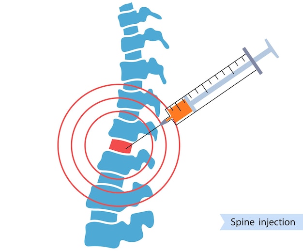 Wirbelsäuleninjektion