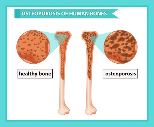 Wissenschaftliche medizinische infografik der osteoporose der knochen