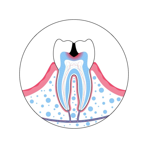 Zahn mit karies-vektor-illustration. medizinisches poster zu zahnverfall. zahnarztpraxis, zahnklinik