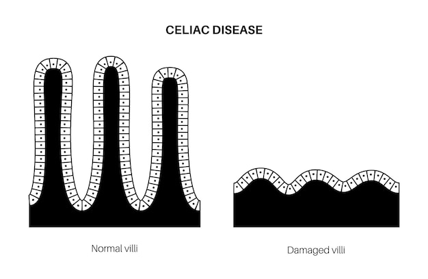 Vektor zöliakie. beschädigte und gesunde darmzotten im oberflächenbereich der darmwände.
