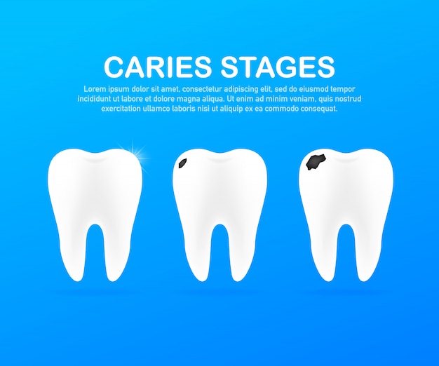 Stage of development of caries. Dental care concept. Healthy Teeth.