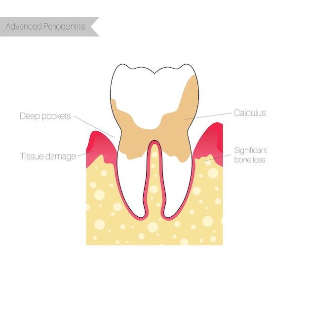 Vector flat isolated illustration of periodontitis. Tooth anatomy infographics