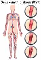 Vetor grátis anatomia de trombose venosa profunda